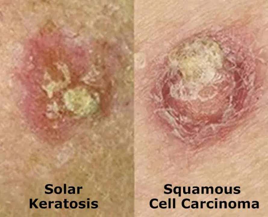 Skin cancer types - Solar Keratosis Squamous Cell Carcinoma